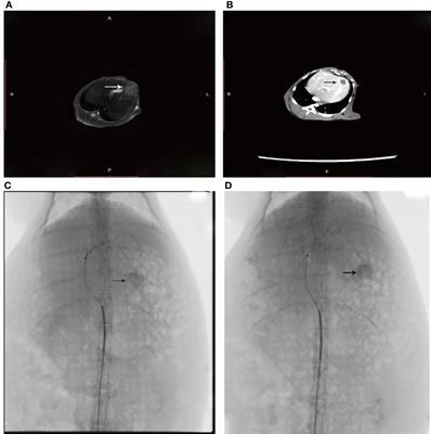 Gut microbiota changes and biological mechanism in hepatocellular carcinoma after transarterial chemoembolization treatment